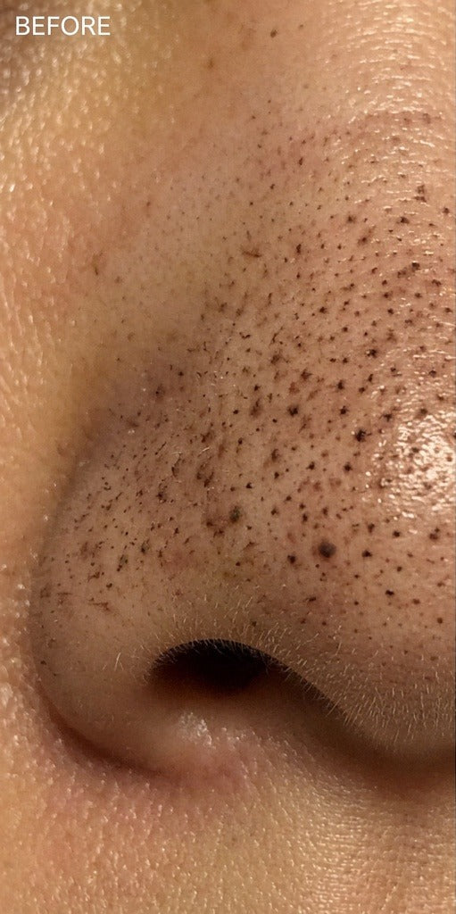 Illustrative · Emma · Day 1 · nose blackheads