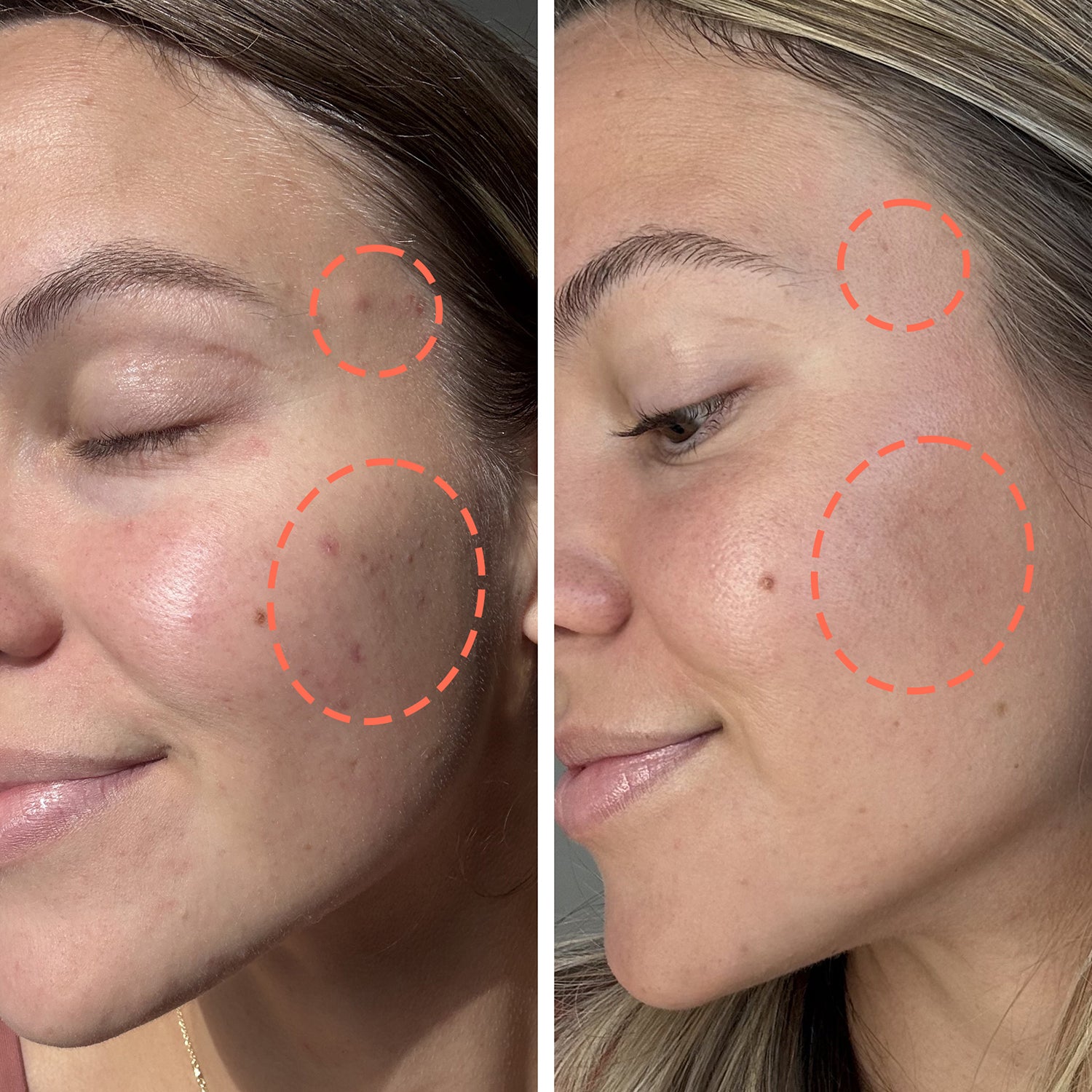 2-week skin transformation for acne and pores