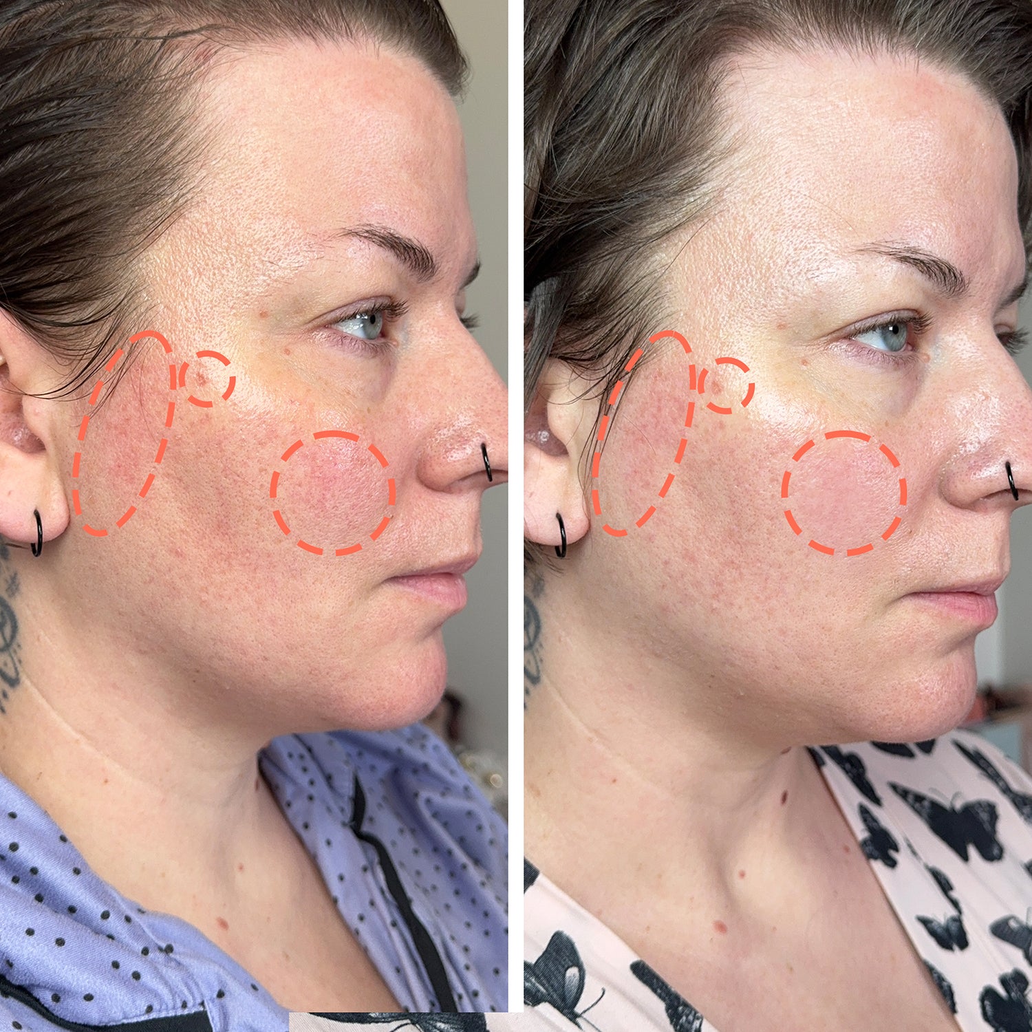 2-week skin transformation for redness