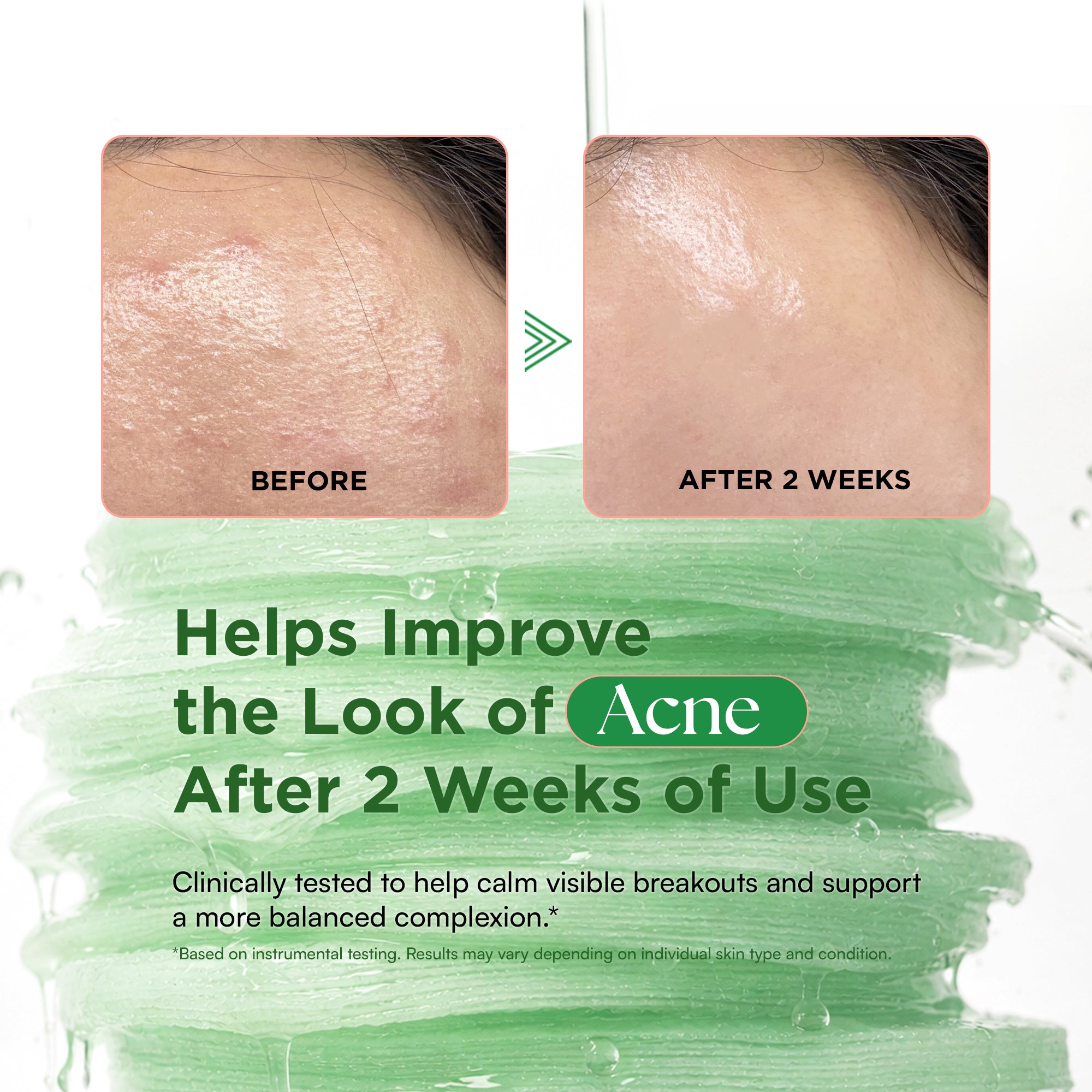 2-week skin transformation for acne and pores